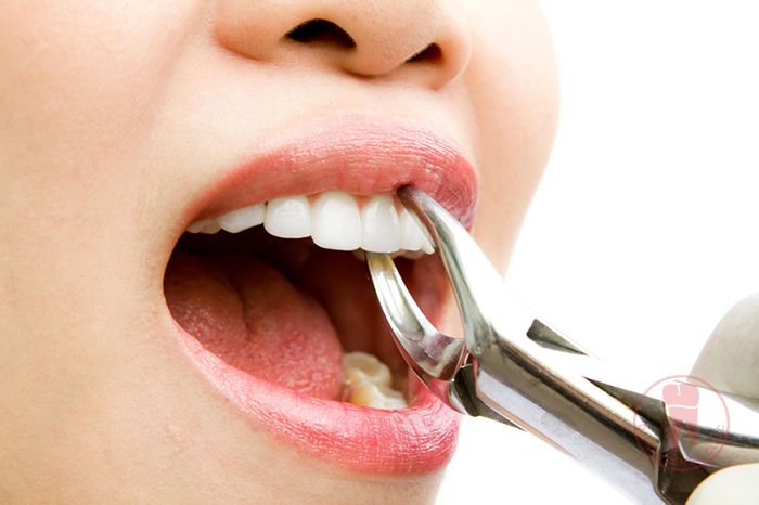 Nhổ răng vĩnh viễn – Giải pháp tối ưu cho răng xấu, răng hư, răng sâu