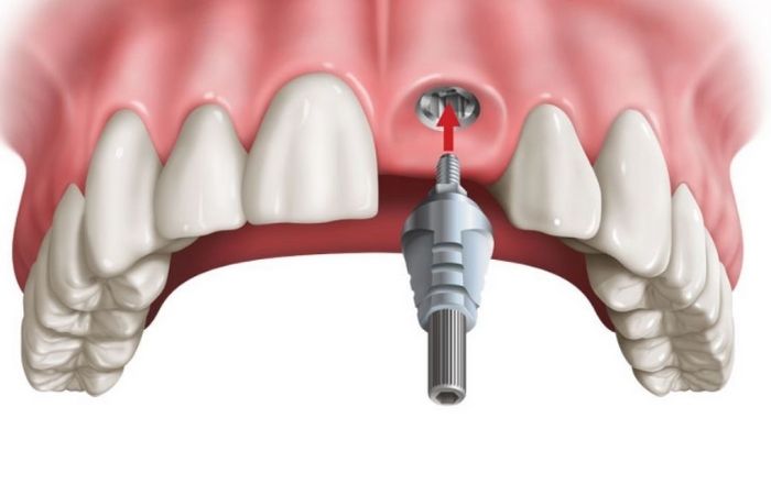 Sau khi nhổ răng có cấy ghép Implant ngay được không?