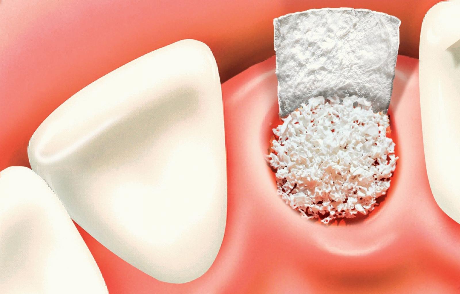 Răng bị tiêu xương gây ra những hậu quả nào? - The Sun Dentist