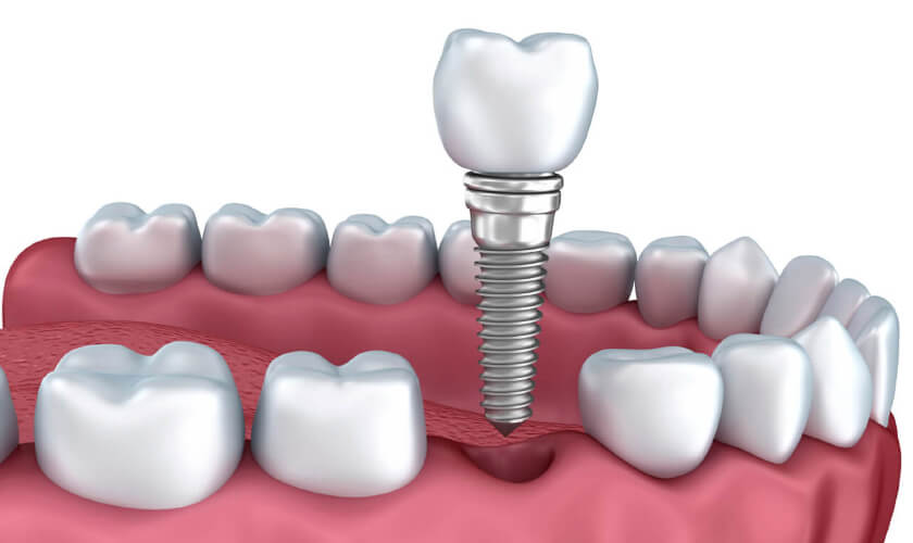 Trồng răng implant tức thì giúp rút ngắn thời gian điều trị - nhakhoathuyanh
