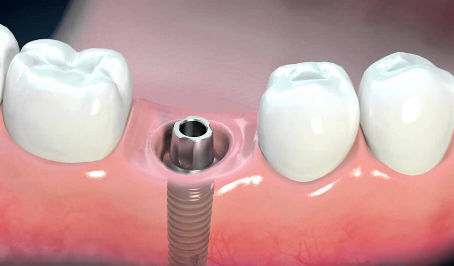 Những trường hợp nên và không nên trồng răng Implant